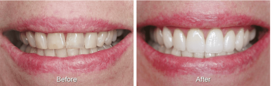 Before and after porcelain veneers