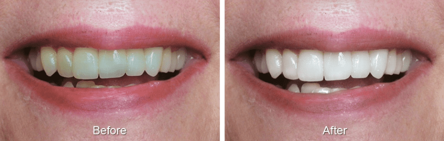 Before and after teeth whitening