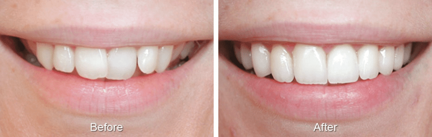 Before and after Invisalign