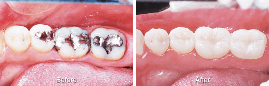 Before and after white dental fillings