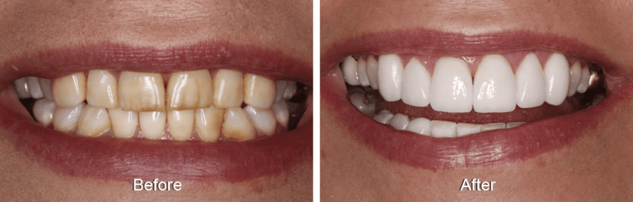 Before and after dental crowns