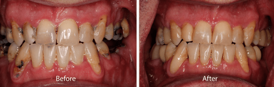 Before and after dental implants