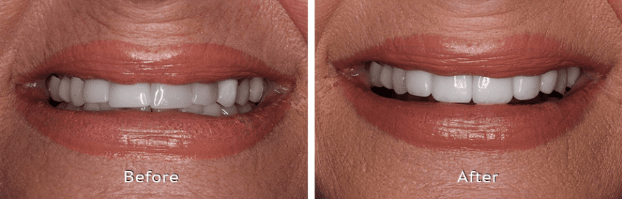 Before and after veneers and crowns