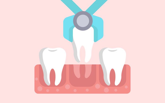 tooth extraction procedure in burkburnett, texas